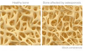 Breast Cancer And Osteoporosis Breast Cancer Now