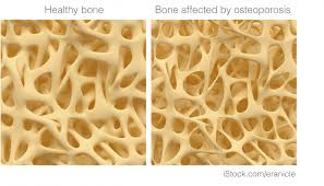 breast cancer and osteoporosis breast cancer now