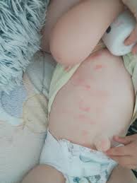 Image result for vyrážka u dětí