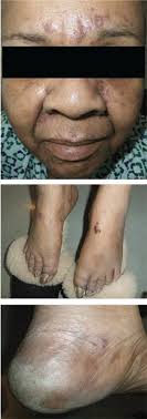 Skin findings associated with nutritional deficiencies