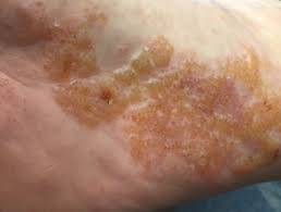 It happens mostly at night on the balls of my feet. Vesicular Hand Dermatitis Dermnet Nz