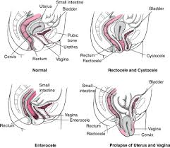 Pelvic Organ Prolapse Pop Women S Health Issues Pelvic Floor Pelvic Floor Prolapse Womens Health Issues