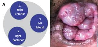 There are internal (inside the anus) and external. Hemorrhoids From Basic Pathophysiology To Clinical Management
