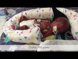 The baby is now a little over half an inch in size. The Gardner Story Baby Charlie Born At 25 Weeks Youtube