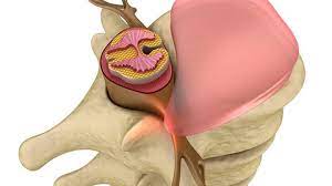 Dimana sumsum tulang belakang adalah bagian dari sistem syaraf dan berperan sebagai pengontrol gerak diantaranya hidung, mata dan lain sebagainya. Mengenal Fungsi Sumsum Tulang Belakang Dan Risiko Penyakitnya
