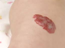 Red spots on skin appear as dry patches or blood spots, flat or raised. Skin Conditions And Birthmarks In Newborns
