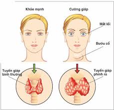 Ung thư tuyến giáp có những triệu chứng không rõ ràng và dễ gây nhầm lẫn với các bệnh thông thường khác ở vùng cổ. Bá»‡nh CÆ°á»ng Giap Co Nguy Hiá»ƒm Khong Vinmec