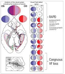 Image result for Visual Field Deficit