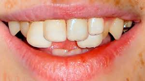 British teeth are not bad, but irregular by american standards. Teeth