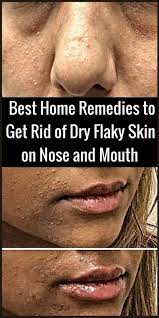 Beauty Dry Skin Around Nose Best Home Remedies To Get Rid Of Dry Flaky Skin On Nose And Mouth Best Primer Dry Flaky Skin Dry Nose Skin Dry Skin On Face