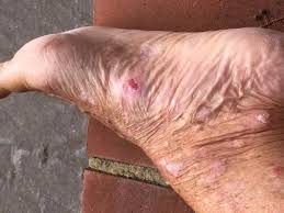 Former model who covered herself in Coke and oil every day is now fighting  skin cancer