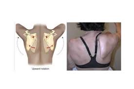 Image result for Winged Scapula