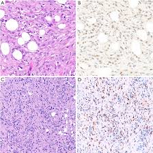 Sarcomatoid mesothelioma is a rare cancer caused by asbestos. Application Of Immunohistochemistry In Diagnosis And Management Of Malignant Mesothelioma Abstract Europe Pmc