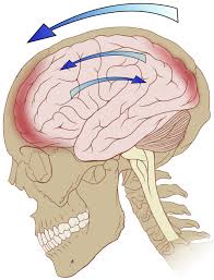 Concussion Whiplash Migraine Related Injuries Migrainepal