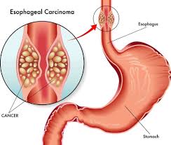 Image result for esophagus