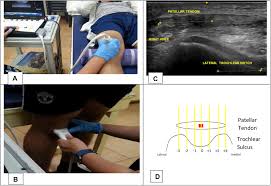 Image result for Patella Tracking Assessment