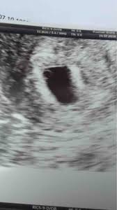 It is also impossible to do a thorough foetal screening assessment because it is still just too premature in for of embryonic development. 6 Weeks 1 Day Internal Scan