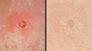 4.2 out of 5 stars 181. Laser Treatment For Vascular Lesions Aventura Fl Fine Facial Blood Vessels Aventura Fl