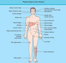 Most liver cancer patients won't experience symptoms until later stages of the disease. Pin On Fatty Liver Symptoms