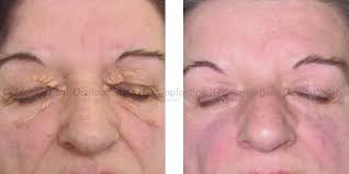 Image result for xantelasma