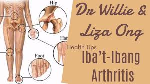 Iba T Ibang Arthritis Osteoarthritis Gout Ni Doc Ging Zamora Racaza Osteoarthritis Arthritis Rheumatologist