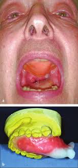 Thieme: Head and Neck Cancer: Management and Reconstruction