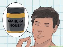 Common causes of ingrowing hair include inappropriate shaving techniques, dry skin, hair follicle diseases and irritants (e.g. 3 Ways To Treat Infected Ingrown Hair Wikihow