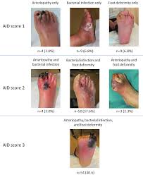 Image result for IDSA Diabetic Foot Wound Classification