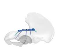 FAP Posterior Column Anatomic Locking Plate,Medical Device ...