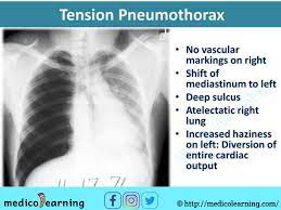 Evidence of recent left chest. Pin On Chest X Ray Interpretation