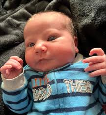 Baby's facial bruising and bloodshot eye after getting stuck during birth