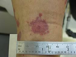 Image result for Erythema Multiforme Major