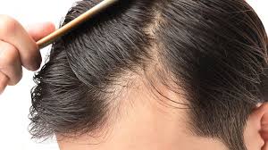 Hair loss and thinning can be tough on a guy's confidence and style 4 how to fix hair loss. Finasteride Vs Minoxidil Which Men S Hair Loss Treatment Is Best