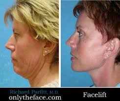 It can be divided into two main categories: Facelift Before And After Photos Dr Richard Parfitt Facelift Before And After Facelift Plastic Surgery