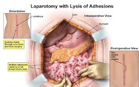 Lysis Of Abdominal Adhesions Symptoms Intestinal Uterine Like Categories Define Abdominal Adhesions Scar Tissue Bowel Obstruction