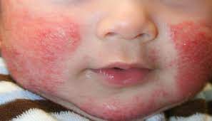 Irritant Contact Dermatitis Pt Mutiara Medical Service