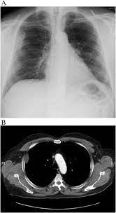 By forgoing a tissue biopsy, there is less risk of morbidity of the patient. Pet Ct In The Diagnosis Of Localized Malignant Pleural Mesothelioma Clinical Imaging