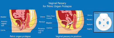 Image result for Pessary