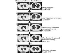 Doxil/avastin and hair loss ? Bevacizumab Treatment For Advanced Non Small Cell Lung Cancer A Case Report