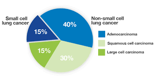 Types Of Lung Cancer Lung Cancer Foundation Of America