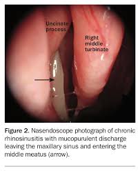Image result for Rhinosinusitis