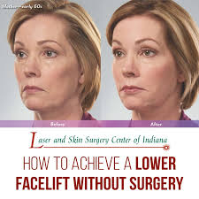 Hairstyles for women over 50 with gray hair. Sagging Jowls Archives Laser And Skin Surgery Center Of Indiana