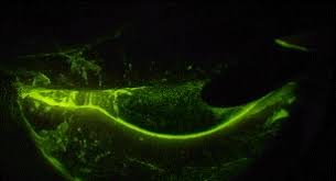 Image result for Seidel Test