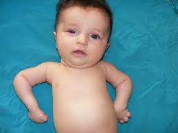 Bilateral Brachial Plexus Palsy And Right Horner Syndrome Due To Congenital Cervicothoracal Syringomyelia Brain And Development