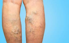 Can Varicose Veins Cause High Blood Pressure?