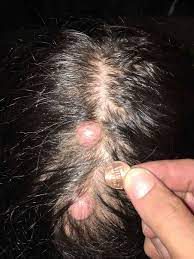 Some of them can be found to be cancerous but most are not. Trichilemmal Cyst Causes Signs Symptoms Diagnosis Treatment