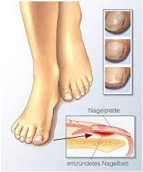 Nagelbettentzundung Ursachen Symptome Behandlung Medlexi De