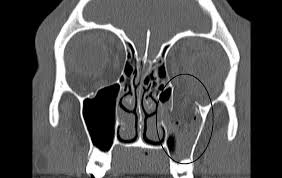 How to take care of a broken nose? Broken Eye Socket Pictures Causes And Treatment