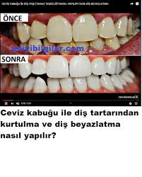 Ceviz Kabugu Ile Dis Beyazlatma Dis Tartarlarinizdan Ceviz Kabugu Ile Kurtulurken Ayni Zamanda Dislerinizin K Convenience Store Products Pill Convenience Store