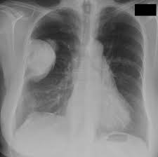 Some of these opacities are clearly bordering the chest wall (red arrows). Sarcomatoid Mesothelioma Radiology Case Radiopaedia Org